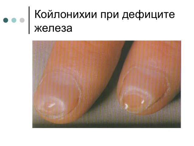 Ногти исчерченность ногтей Ногти исчерченность ногтей